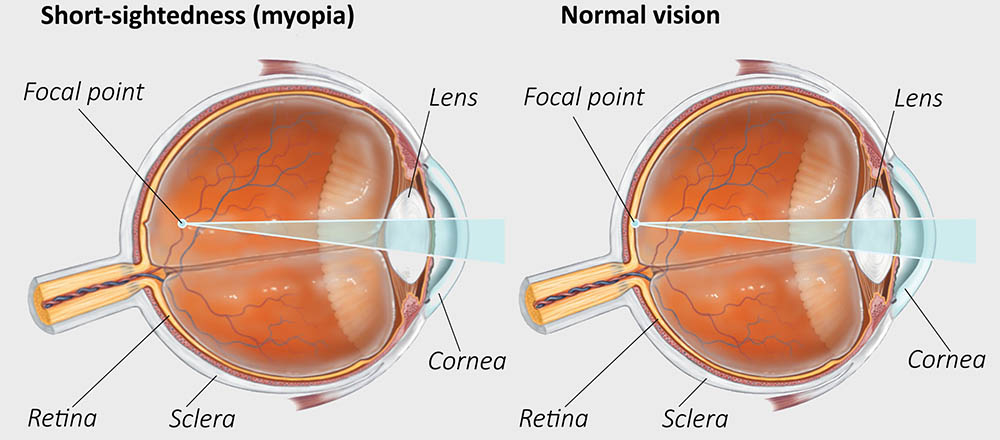 Spotlight On Myopia EyeQ Optometrists